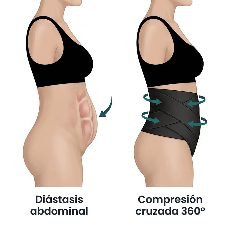 Diástasis abdominal frente a la compresión cruzada 360°